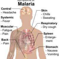 Symptoms_of_Malaria.png